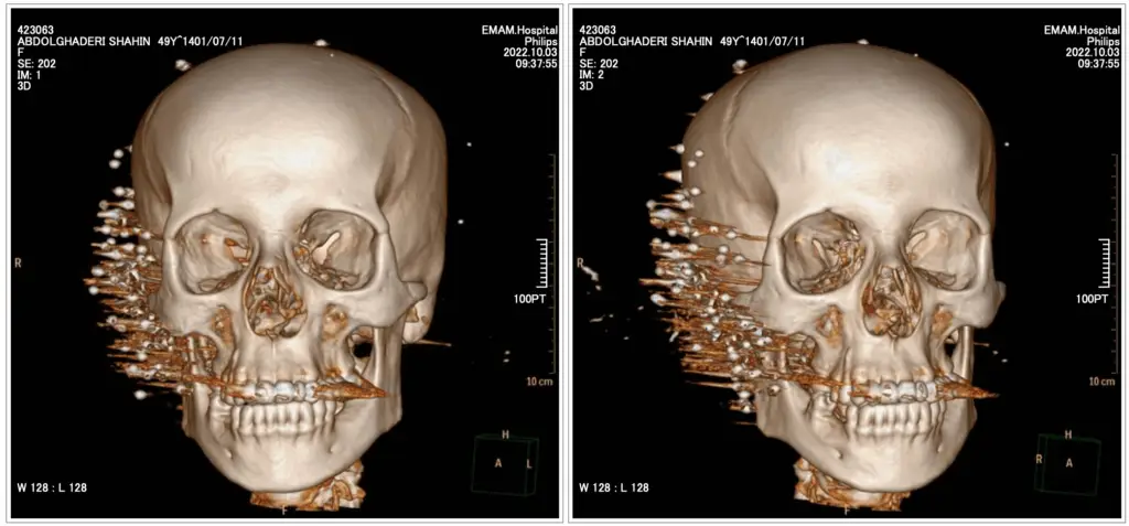 Medical image 5 of 5: Shahin Abdolghaderi’s injuries