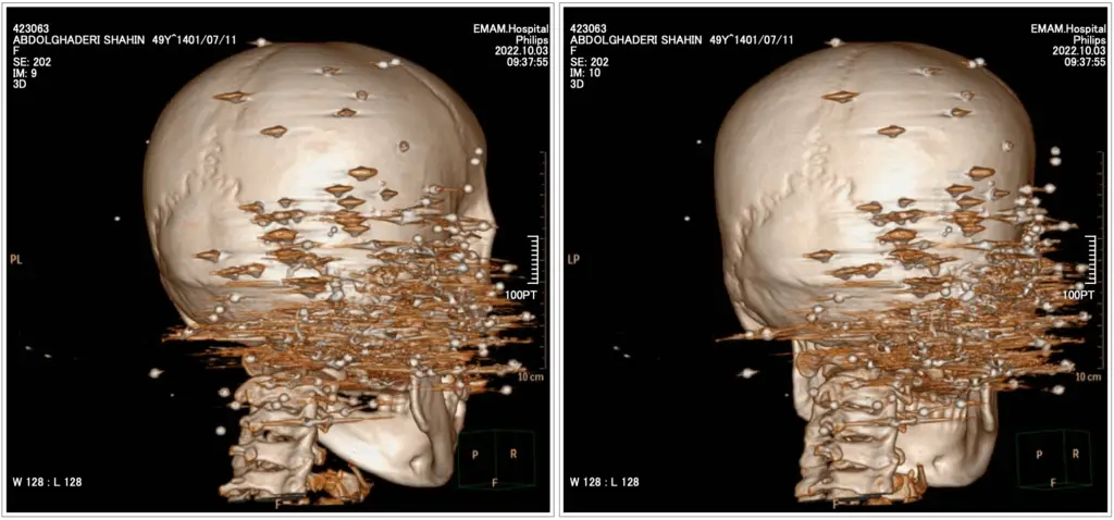 Medical image 3 of 5: Shahin Abdolghaderi’s injuries